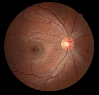 OD Fundus